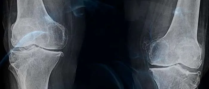 10 Biblical meaning of dreaming of bones