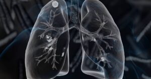 Dreaming of Tuberculosis